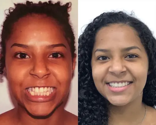 Comparativo antes e depois de uma mulher com dentes alinhados após tratamento ortodôntico.